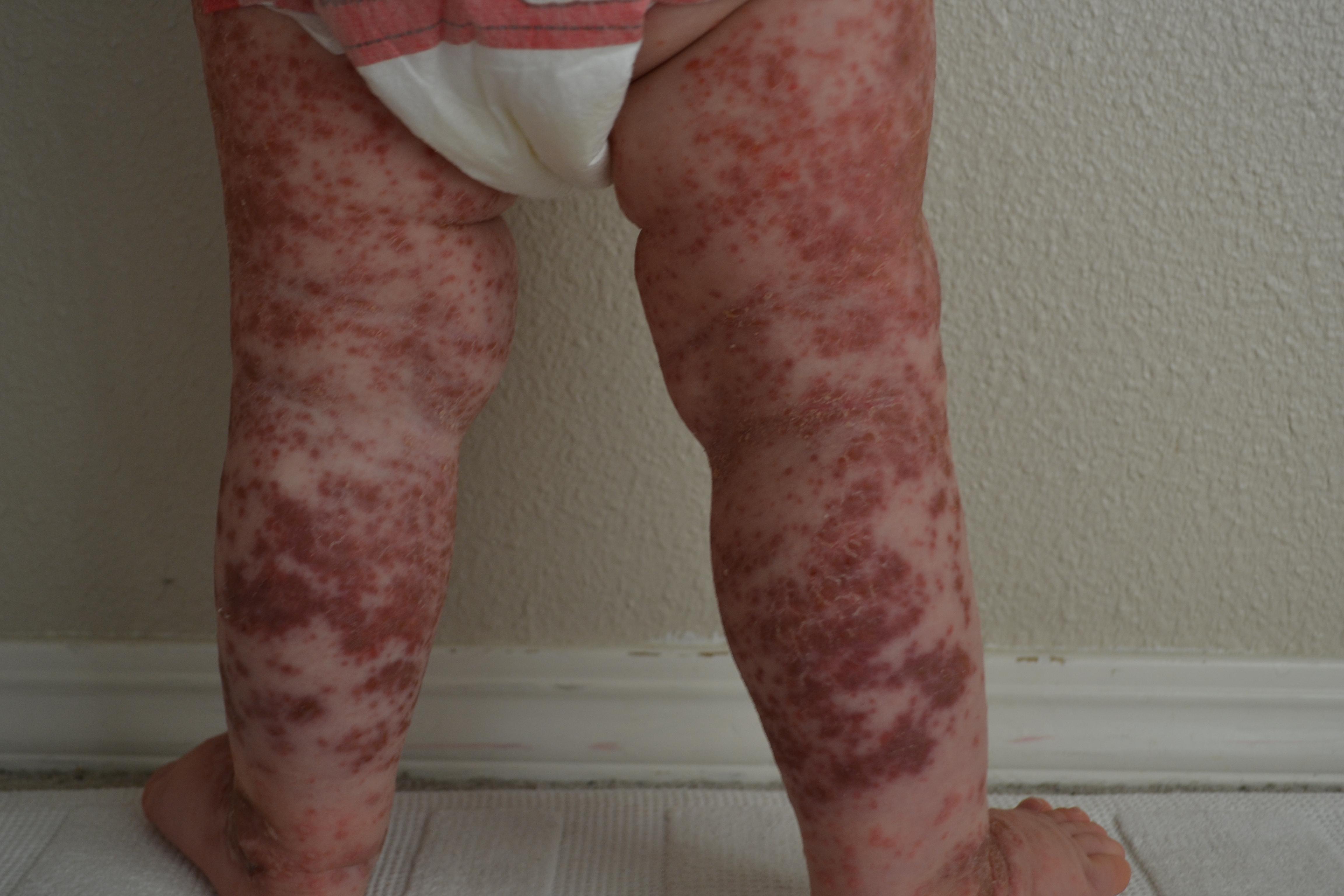 toddler rashes on legs
